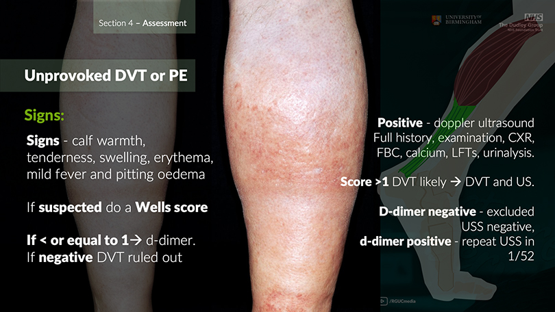 Pulmonary Embolism lecture screenshot from DVT and PE module